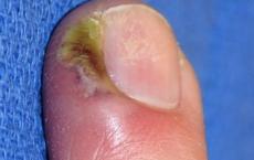 Почему образуется пустота под ногтем: причины и лечение Гноится под ногтем на ноге чем лечить
